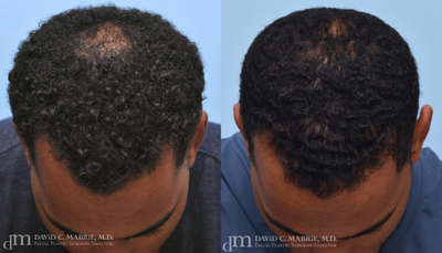 PRP for Hair Loss before and after photo
