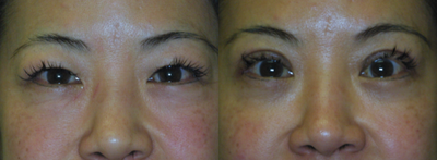 Double Eyelid Surgery before and after photo