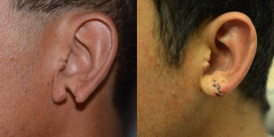 Earlobe Repair before and after photo