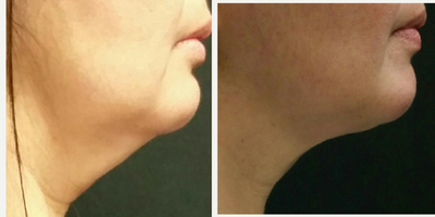 Kybella before and after photo