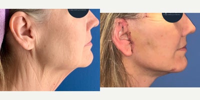 before and after image