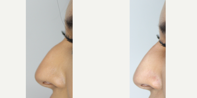 Nonsurgical Nose Job before and after photo