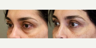 Eyelid Surgery before and after photo