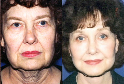 Facelift before and after photo
