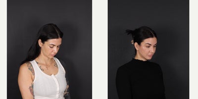 Neck Lift before and after photo