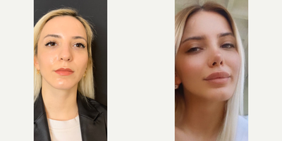 Rhinoplasty before and after photo