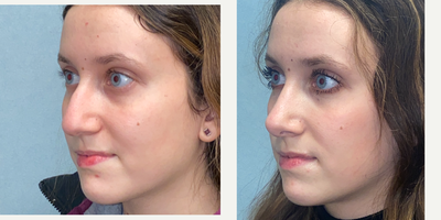 Rhinoplasty before and after photo
