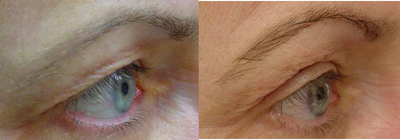 Thermage before and after photo