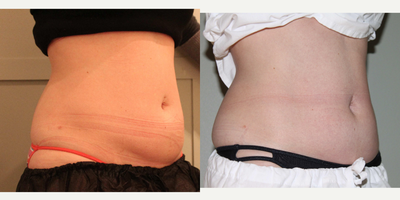 CoolSculpting before and after photo
