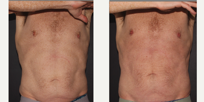 Emsculpt before and after photo