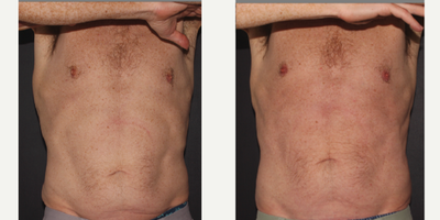 Emsculpt before and after photo