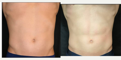 Emsculpt before and after photo