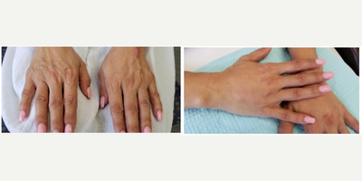 Hand Rejuvenation before and after photo