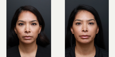 Lip Fillers before and after photo