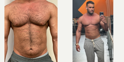 Liposuction before and after photo