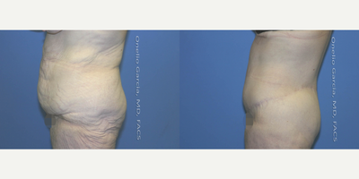 Body Lift before and after photo