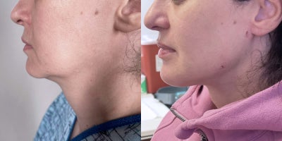 Chin Liposuction before and after photo