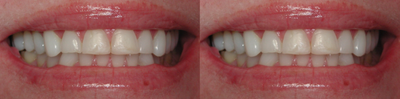 Porcelain Veneers before and after photo
