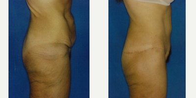 Tummy Tuck before and after photo