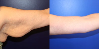 Arm Lift before and after photo