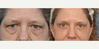Brow Lift before and after photo