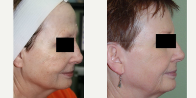 CO2 Laser before and after photo