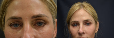 Fractora RF before and after photo