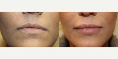 Juvederm before and after photo