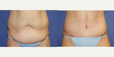 Tummy Tuck before and after photo