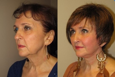 Eyelid Surgery before and after photo