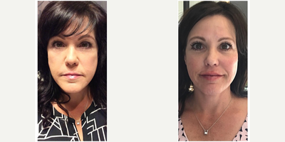 Juvederm before and after photo