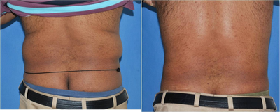 Liposuction before and after photo