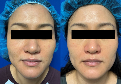 PicoSure before and after photo