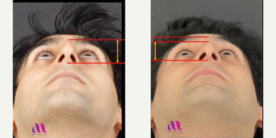Rhinoplasty before and after photo