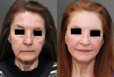 Skin Rejuvenation before and after photo