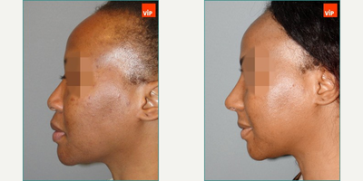 African American Rhinoplasty before and after photo