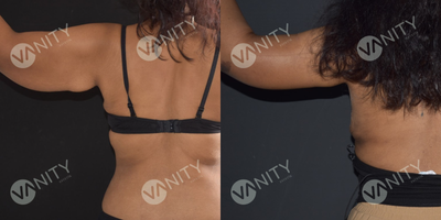 Arm Lift before and after photo