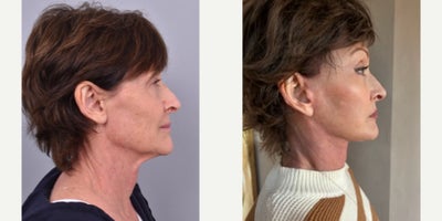 Belotero before and after photo