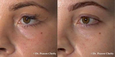 Dermal Fillers before and after photo