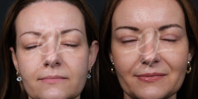 Eyelid Surgery before and after photo