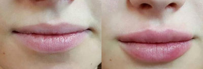 Lip Fillers before and after photo