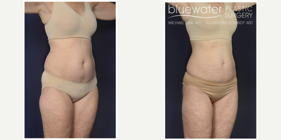Liposuction before and after photo