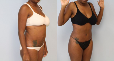 Tummy Tuck before and after photo