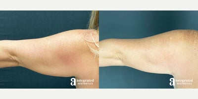 Arm Lift before and after photo