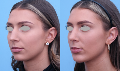 Chin Implant before and after photo