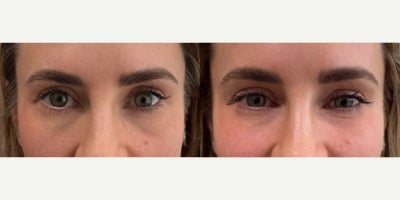 Dermal Fillers before and after photo