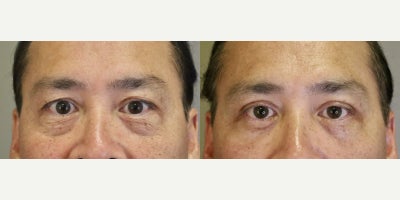Double Eyelid Surgery before and after photo