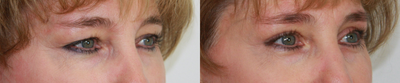 Eyelid Surgery before and after photo
