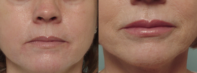 Juvederm before and after photo