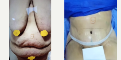 Liposuction before and after photo